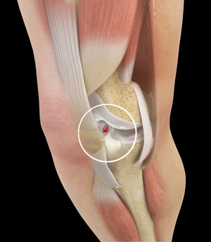 How to diagnose and treat an ACL tear